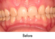 esthtic crown lengthening before