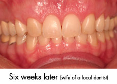 esthtic crown lengthening after