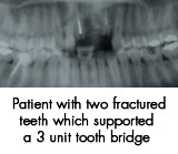 Patient with two fractured teeth which supported a 3 init tooth bridge 