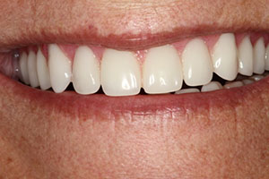 Beautiful Smile with Dental Implants