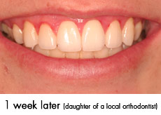 esthtic-crown-lengthening-after