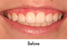 Periodontal Cosmetic Surgery in Orange County and Mission Viejo