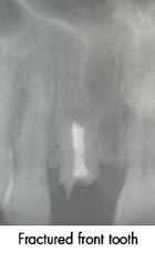 Fractured Front Tooth