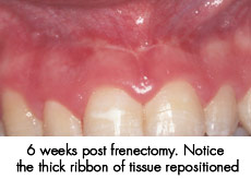 frenectomy after