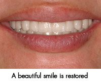 Beautiful restored smile