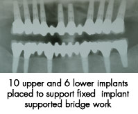 full-arch-replacement-xrayS