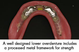 A well designed lower overdenture includes a process meatal framework for strength