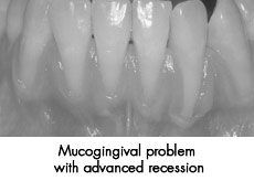 Mucogingival surgery before