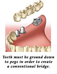 Teeth must be ground down to peg in order to create a conventional bridge