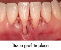 gum recession after