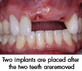 Two implants are placed after the two teeth are removed