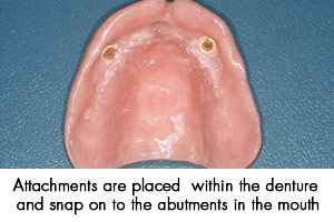 Dental implant denture