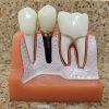 Dental Implants Will Help Give You That Smile You Always Wanted